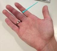 Как сломать палец без боли и причины