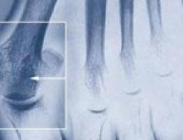 a csípőízületek deformáló artrózisa 3 fokkal