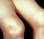 膝関節が傷ついた場合の対処方法