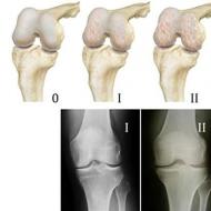 Locītavu (ceļa, pleca) artroze-artrīts: artrozes ārstēšana