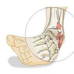 Ayakların bağlarının gerilmesi ve yırtılması için tedavinin belirtileri ve ilkeleri