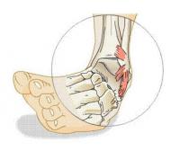 Ayakların bağlarının gerilmesi ve yırtılması için tedavinin belirtileri ve ilkeleri