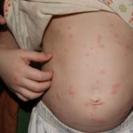 蕁麻疹：臨床症状、病気の原因、治療、ダイエット、予防