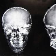 肺、脊椎、副鼻腔の X 線写真の見方 X 線写真を撮る
