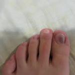 手または足の青い爪 – 原因、治療と予防、起こり得る合併症