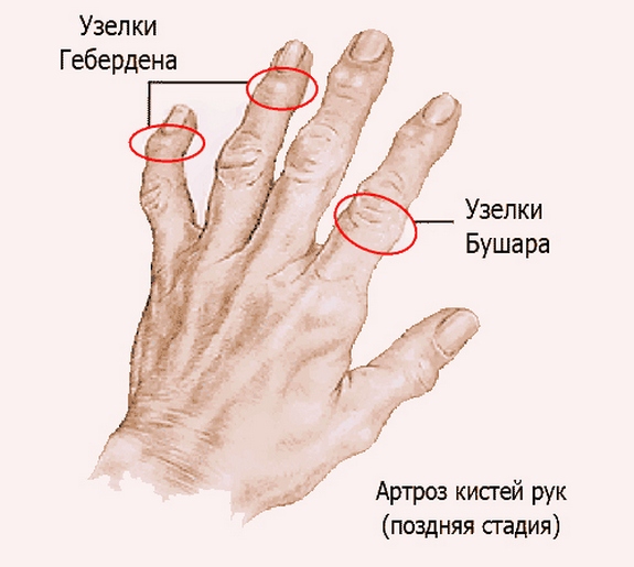 Modern módszerek a deformáló artrózis kezelésére. Reumatoid artritisz – Wikipédia