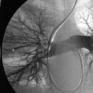 Plaušu artērijas zaru trombembolija: patofizioloģija, klīniskā aina, diagnostika, ārstēšana DVT klīniskās izpausmes