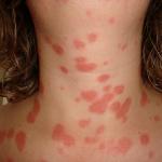 क्या होगा अगर त्वचा एलर्जी और लाल धब्बे खुजली?