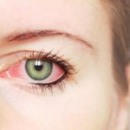 Sarkanas acis: cēloņi un ārstēšana
