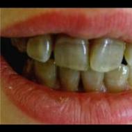 テトラサイクリン歯の治療、美白、ベニアリングテトラサイクリン歯とは
