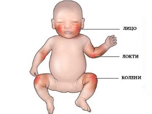 Osip na trbuhu bebe nakon groznice