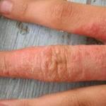Allergia a kezében: kezelés