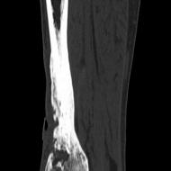 Osteomyelitis szövődményei. A lábak osteomyelitisje