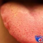 Neden dudaklar, dilin ucu veya ağızda damak uyuşur - nasıl olunur ve ne yapılır?