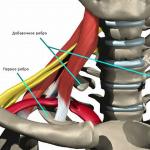 子宮頸部肋骨症候群および肋軟骨症候群