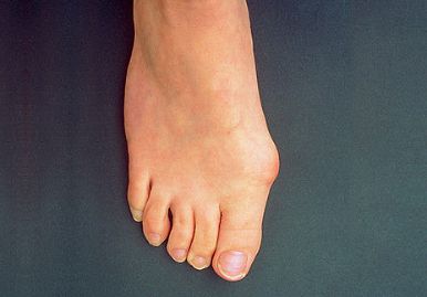a nagy lábujj ízületének elmozdulása mi okozza ízületi és hátfájást