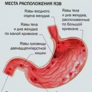 Gyomornehézség elleni gyógyszerek Mit kell enni, ha elnehezül a gyomor