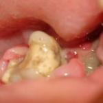 दांत निकालने के बाद एल्वोलिटिस: क्लिनिक और घर पर लक्षण, फोटो, उपचार