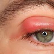 目の下の腫れを引き起こす病気は何ですか？