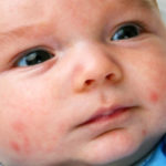Osip na telu djeteta - što je to, glavni uzroci osipa, što liječiti, što je osip, kako izgleda na fotografiji