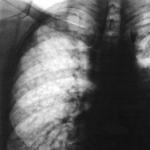 Akciğer alveolitinin semptomları ve tedavi yöntemleri