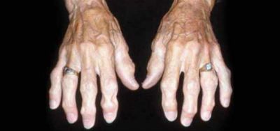 a kezek ízületeinek nodularis artrózisa