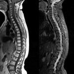 Vertebrogen és vertebralis thoracalgia - mellkasi fájdalom Thoracalgia kezelés népi gyógymódokkal