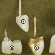歯冠の種類、比較分析、違い、長所と短所、価格