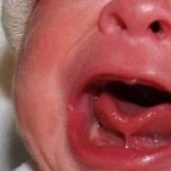 小児の短い舌小帯は顎の形成に悪影響を及ぼします 乳児の短い舌小帯の兆候