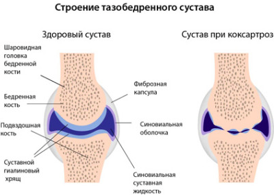 térdkészítmények deformáló osteoarthrosisa)