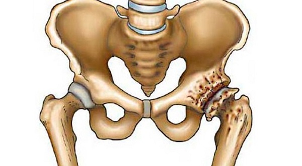 3. a csípőízület deformáló artrózisa. kezelés