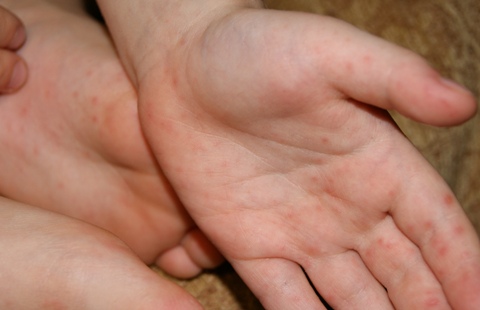 Hogyan alakul ki a kiütés a gyermek tenyerein, kezén és lábán