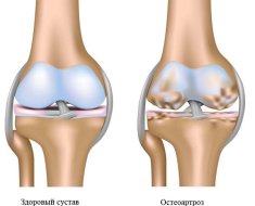 Osteoarthritis a bokaízület tünetek és a kezelés fok