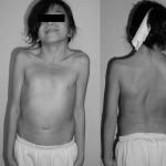 モリス症候群: 男の子が男の子ではなく、アンドロゲンが機能しない場合。この病気は治療する必要がありますか?