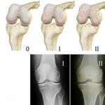 関節症-関節炎（膝、肩）：関節症の治療