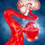 くも膜下脳出血の原因と兆候 くも膜下脳出血の影響