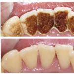 Mi történik a dohányos fogaival: hogyan kell helyreállítani és fehéríteni