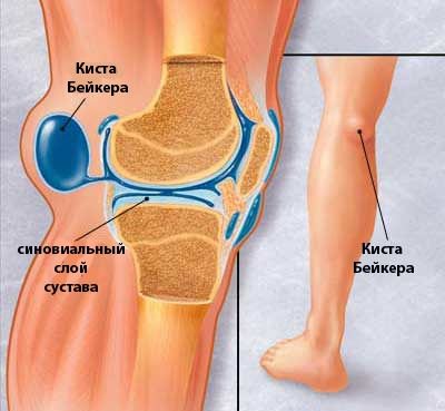 hogyan lehet kezelni a 4. fokozatú artrózist a lábízület éjszaka fáj