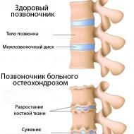 Hastalığın belirtileri - bel omurga ağrısı