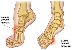 a láb diszlokációjának kezelése fájdalom az ujjak ízületeiben és izületeiben