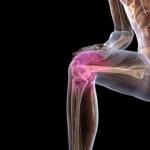 Hogyan kell kezelni a lábak arthrosist otthon