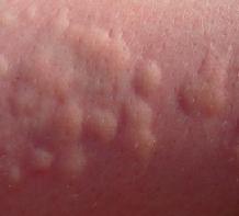 大人の体のアレルギー性の発疹の治療