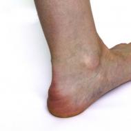 歩行時の踵の痛みの治療