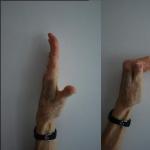 Egyéb módszerek a kézfej szivattyúzására