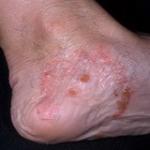 足の真菌性湿疹