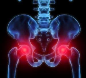 Hip bursitis - okok, tünetek, szövődmények, kezelés és megelőzés